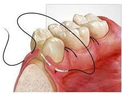 dental Surgical sutures